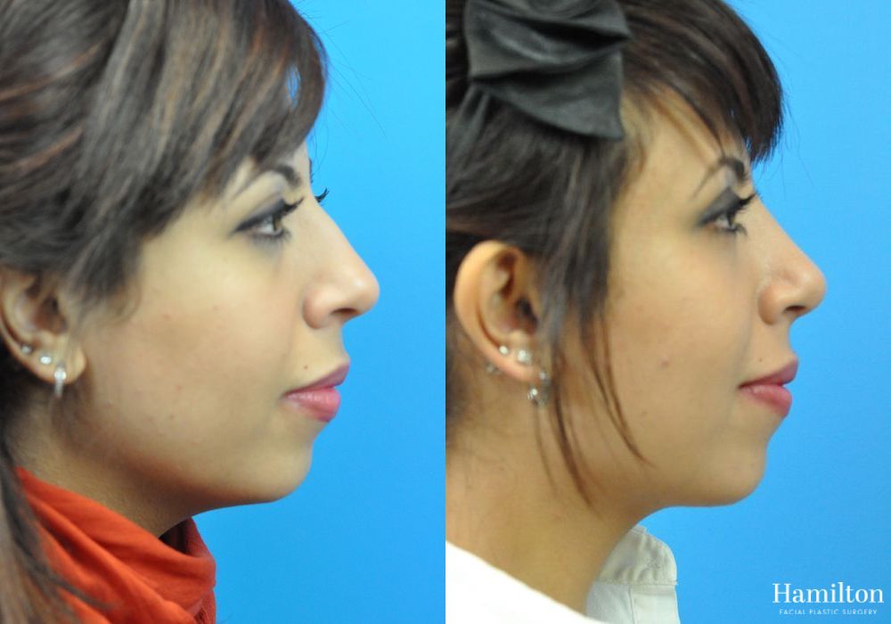 Before and after Rhinoplasty case 37268 - Angle 3