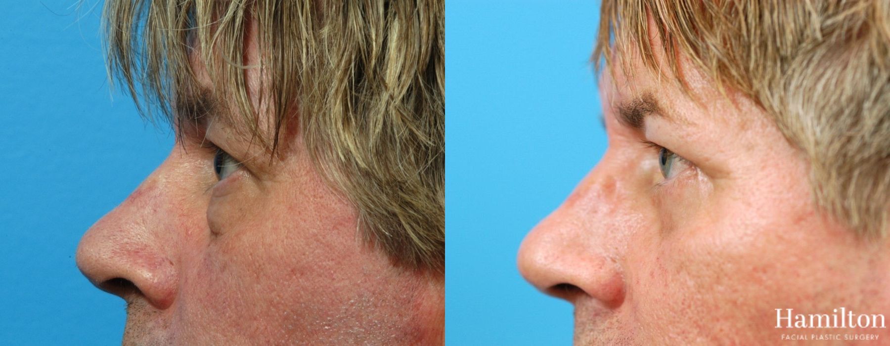 Before and after Blepharoplasty case 37309 - Angle 4