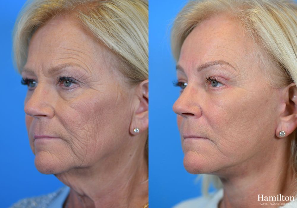 Before and after Facelift case 37233