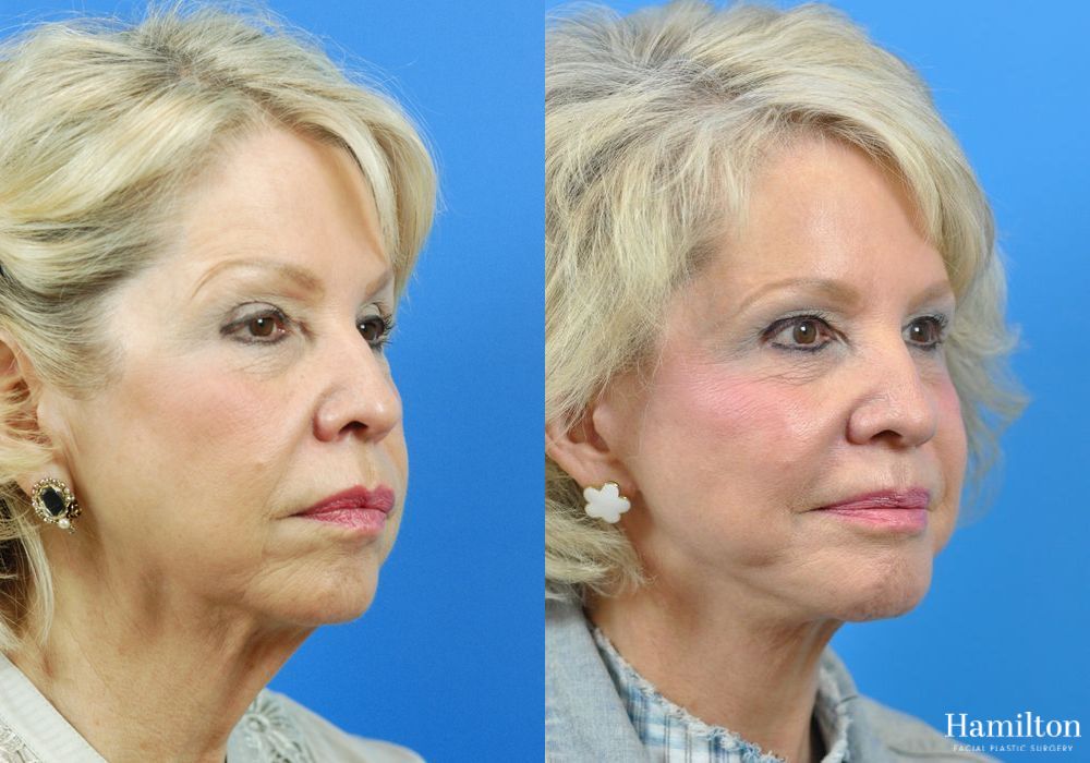 Before and after Chin Augmentation case 37193 - Angle 2