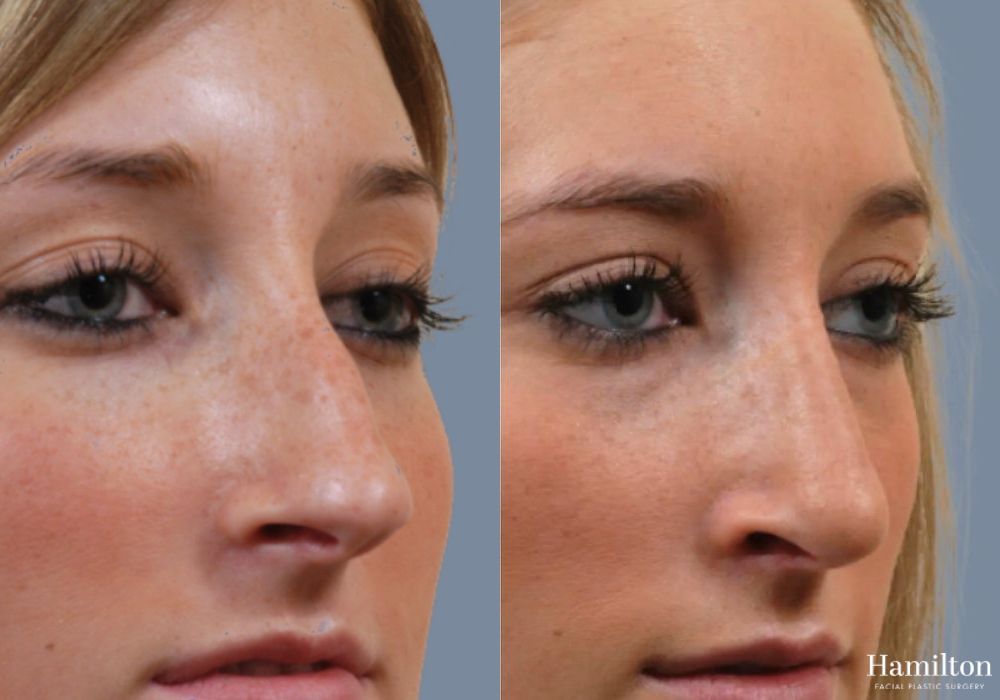 Before and after Rhinoplasty case 37211 - Angle 3