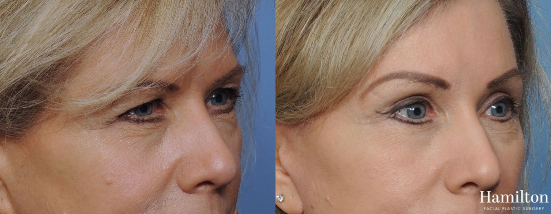 Before and after Blepharoplasty case 37253