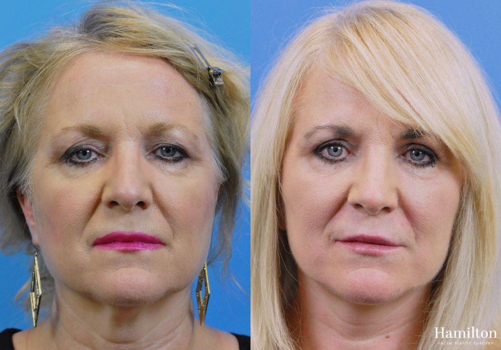 Before and after Facelift case 37266 - Angle 4