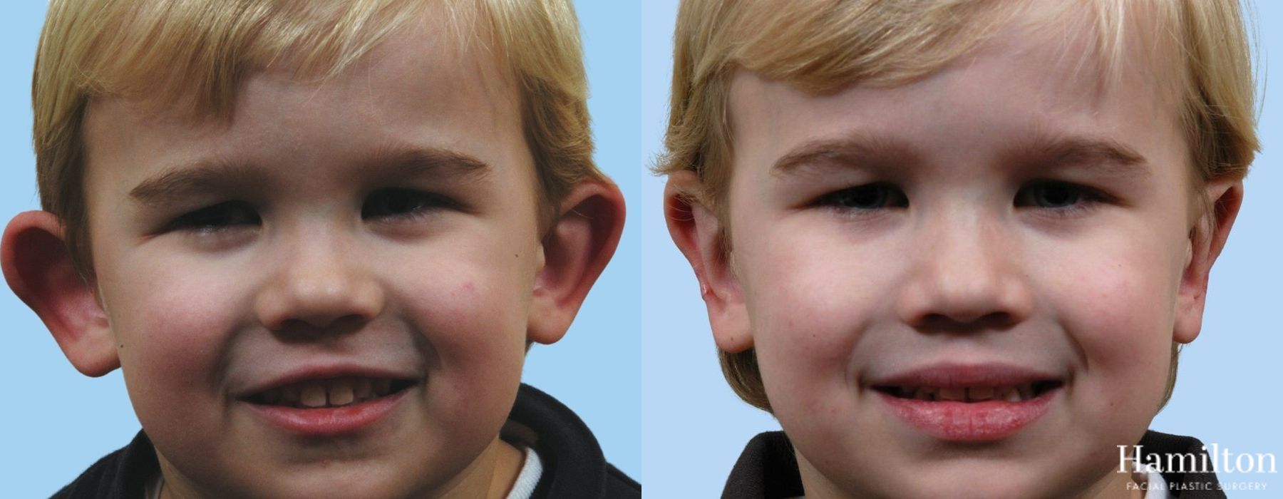 Before and after Otoplasty case 37105