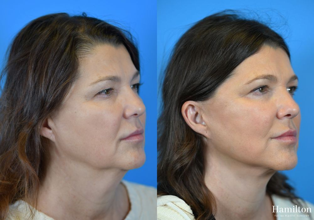 Before and after Facelift case 37254 - Angle 2