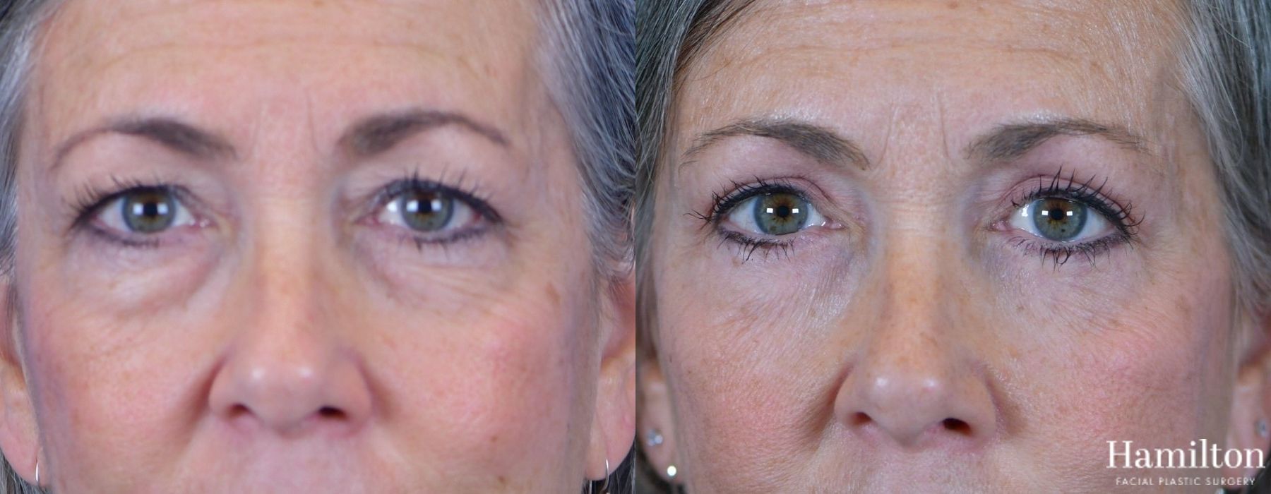 Before and after Blepharoplasty case 37267