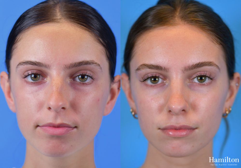 Before and after Rhinoplasty case 37198 - Angle 3