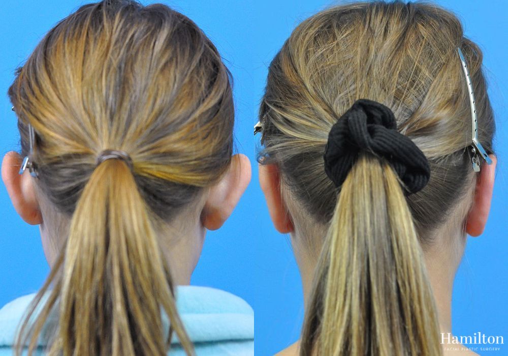 Before and after Otoplasty case 37149 - Angle 2