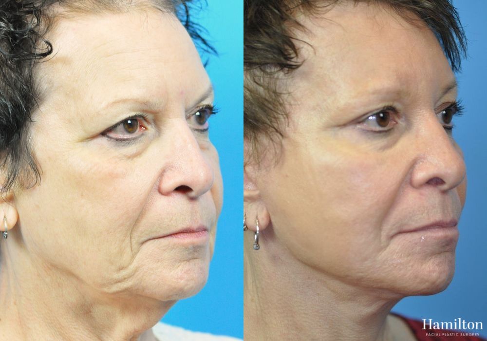 Before and after Brow Lift case 37232 - Angle 2