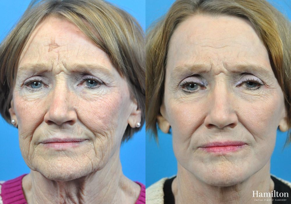 Before and after Laser - CO2 case 37231 - Angle 3