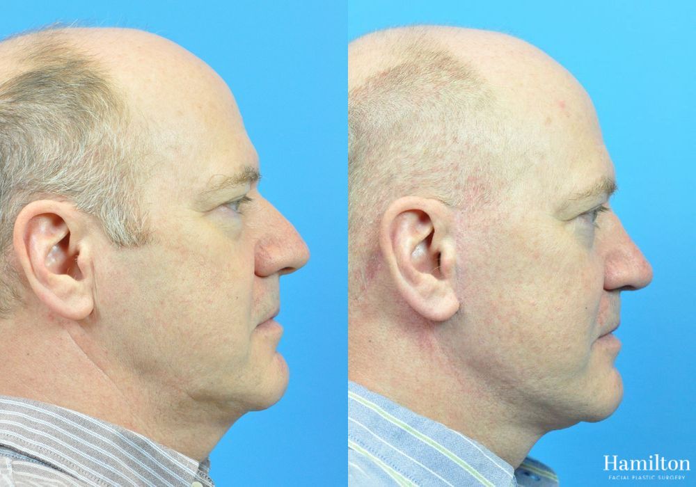 Before and after Facelift case 37306