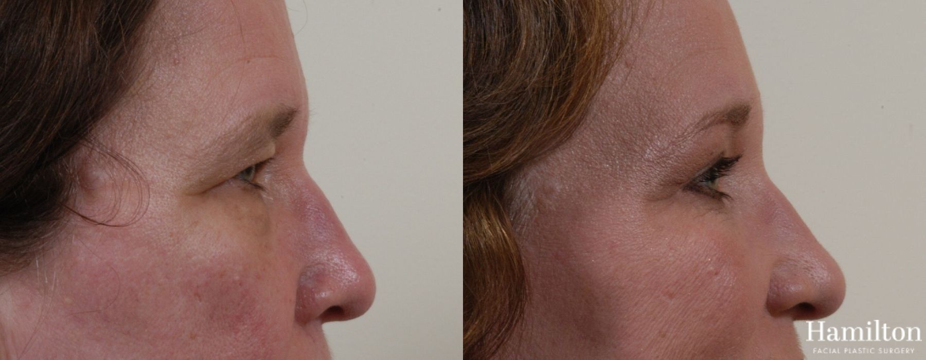 Before and after Blepharoplasty case 37270 - Angle 5