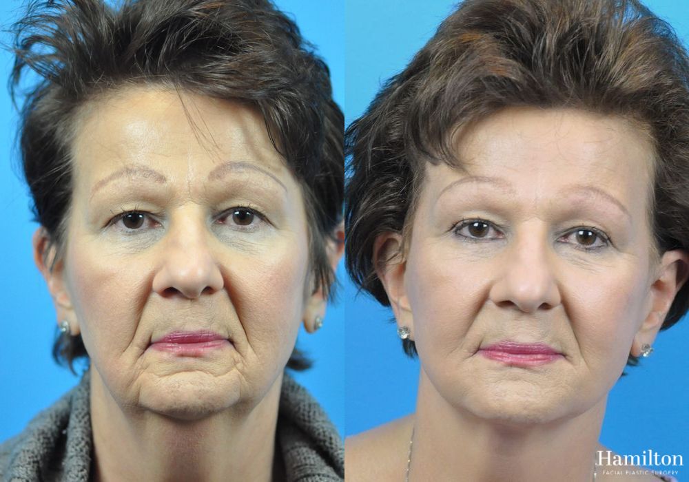 Before and after Facelift case 37325 - Angle 2
