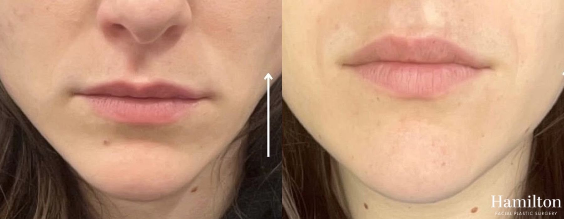 Before and after Neurotoxins/BOTOX case 37202