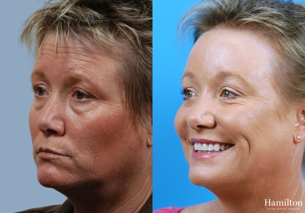 Before and after Laser - CO2 case 37224 - Angle 2