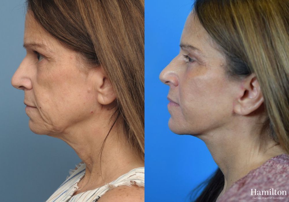 Before and after Facelift case 37273 - Angle 2