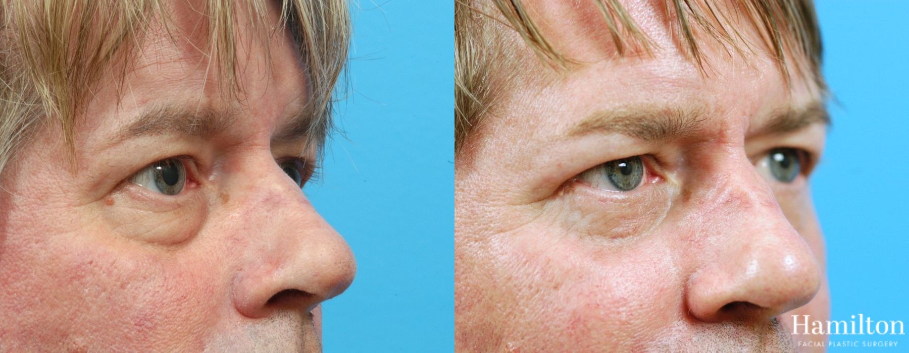 Before and after Blepharoplasty case 37309 - Angle 2