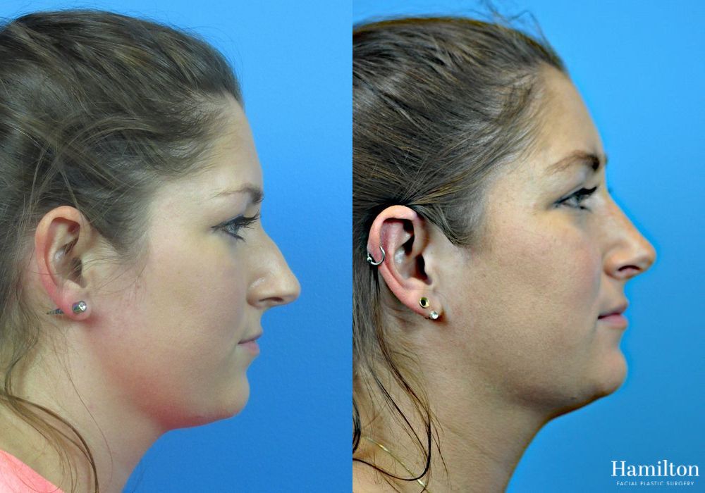 Before and after Rhinoplasty case 37313 - Angle 2