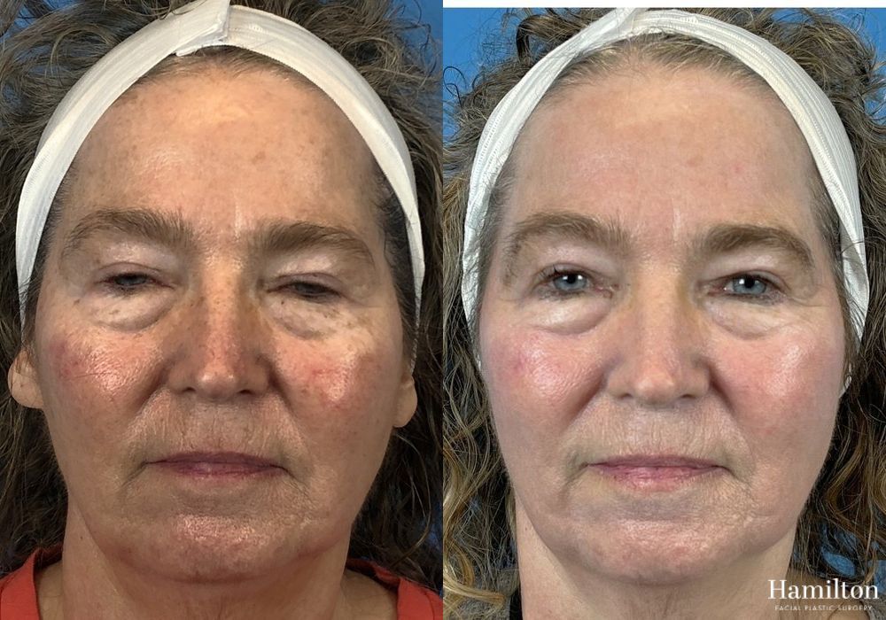 Before and after Laser - HALO case 37362 - Angle 2