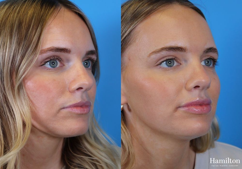 Before and after Lip Enhancement case 37237
