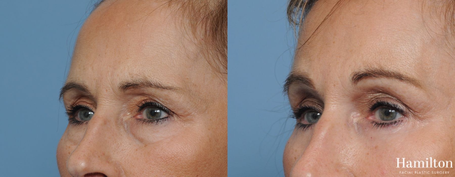 Before and after Blepharoplasty case 37263