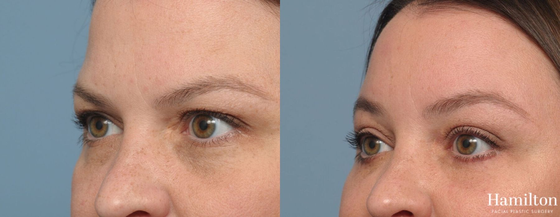 Before and after Brow Lift case 37086 - Angle 2