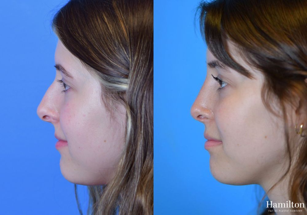 Before and after Rhinoplasty case 37336 - Angle 5
