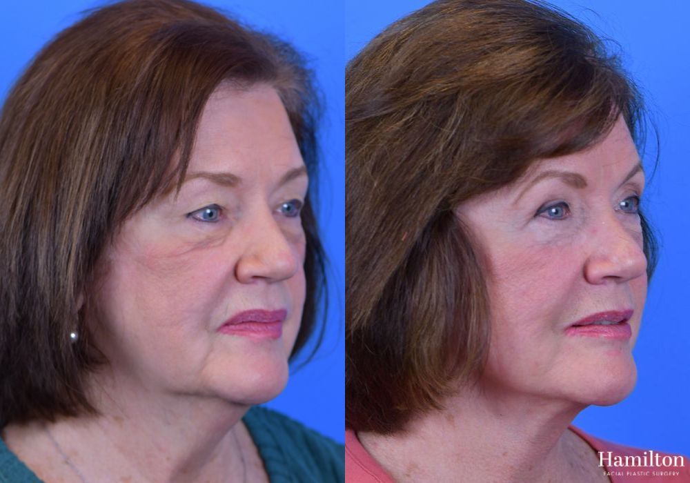 Before and after Facelift case 37291 - Angle 3