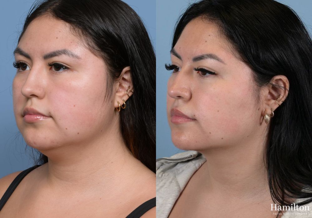 Before and after Submentoplasty/Deep Neck Lift case 37132 - Angle 5