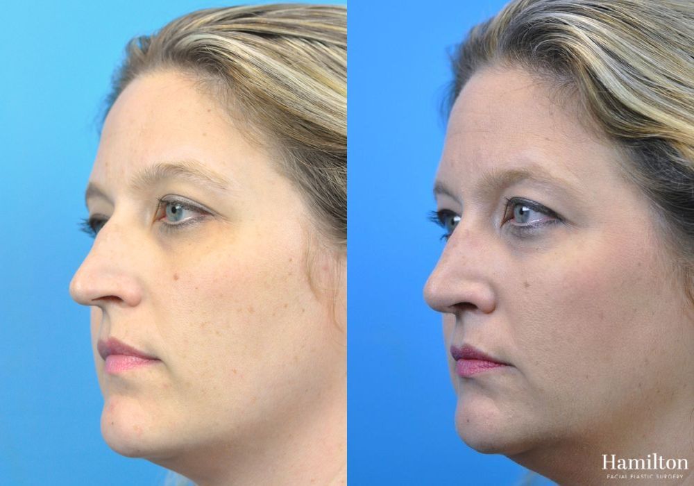 Before and after Rhinoplasty case 37330 - Angle 4