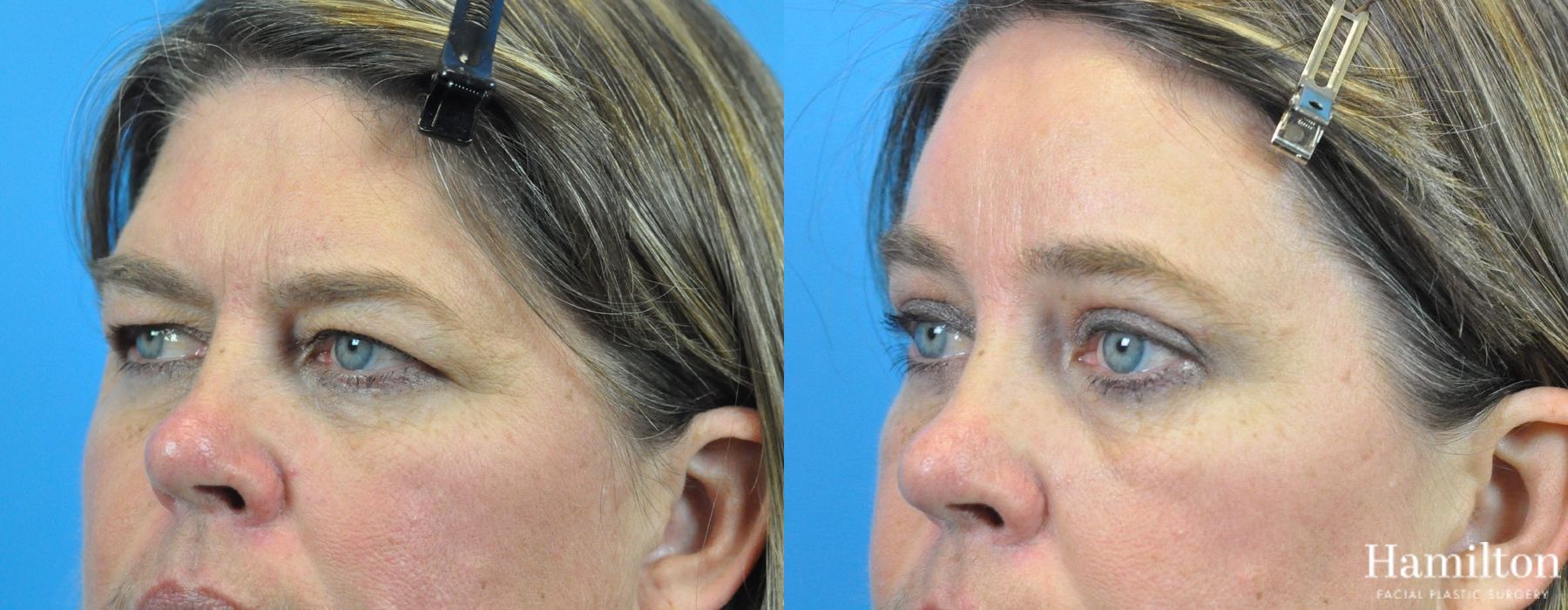 Before and after Brow Lift case 37209 - Angle 2