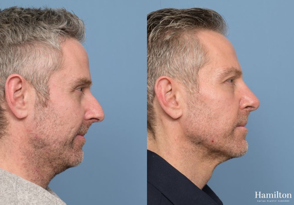 Before and after Rhinoplasty case 37134