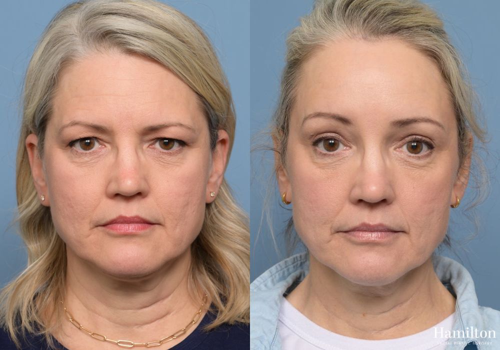 Before and after Brow Lift case 37117