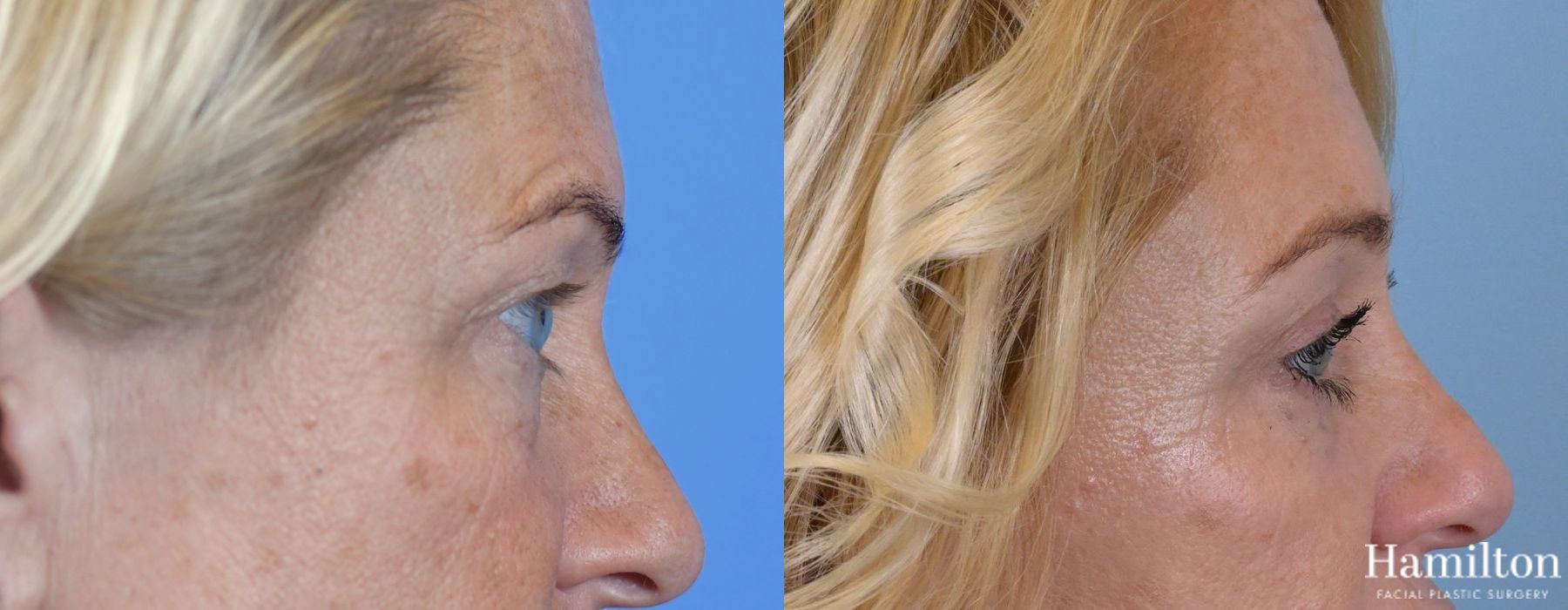 Before and after Blepharoplasty case 37289 - Angle 3