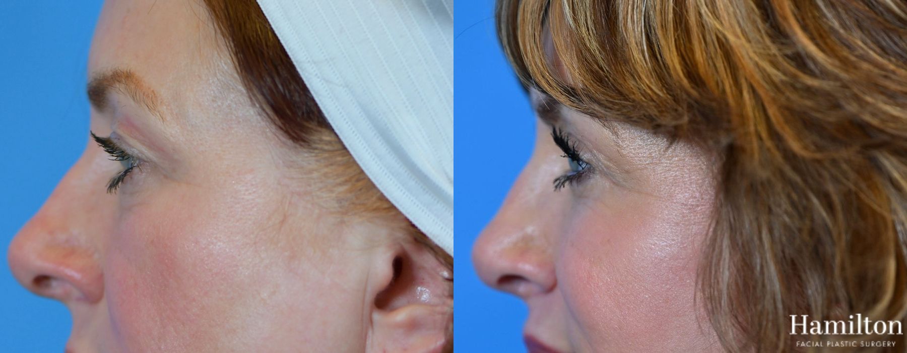 Before and after Blepharoplasty case 37277 - Angle 2