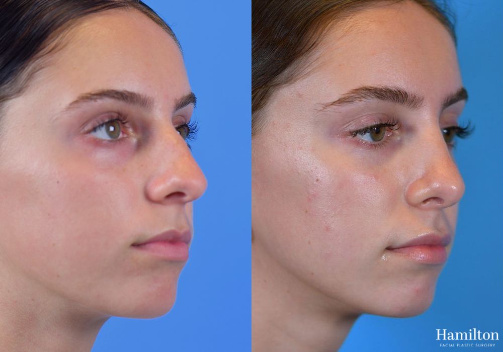 Before and after Rhinoplasty case 37198 - Angle 5