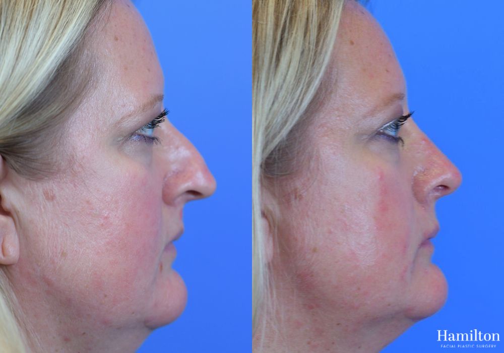 Before and after Rhinoplasty case 37311