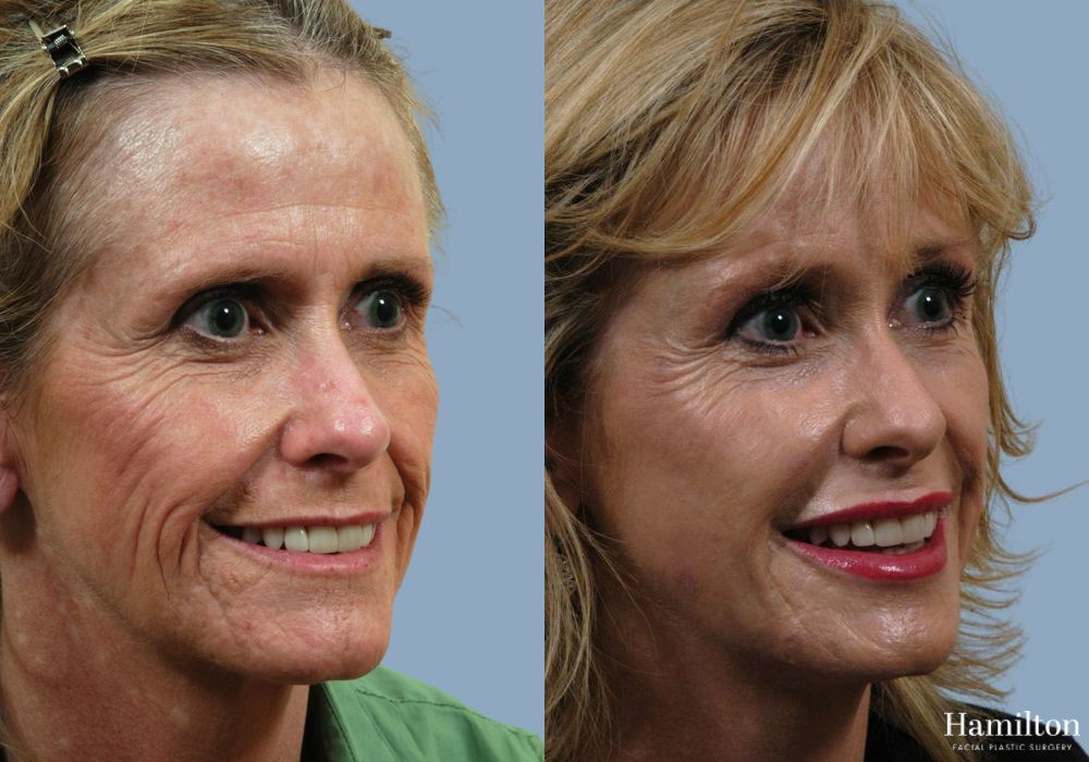 Before and after Laser - CO2 case 37154 - Angle 3