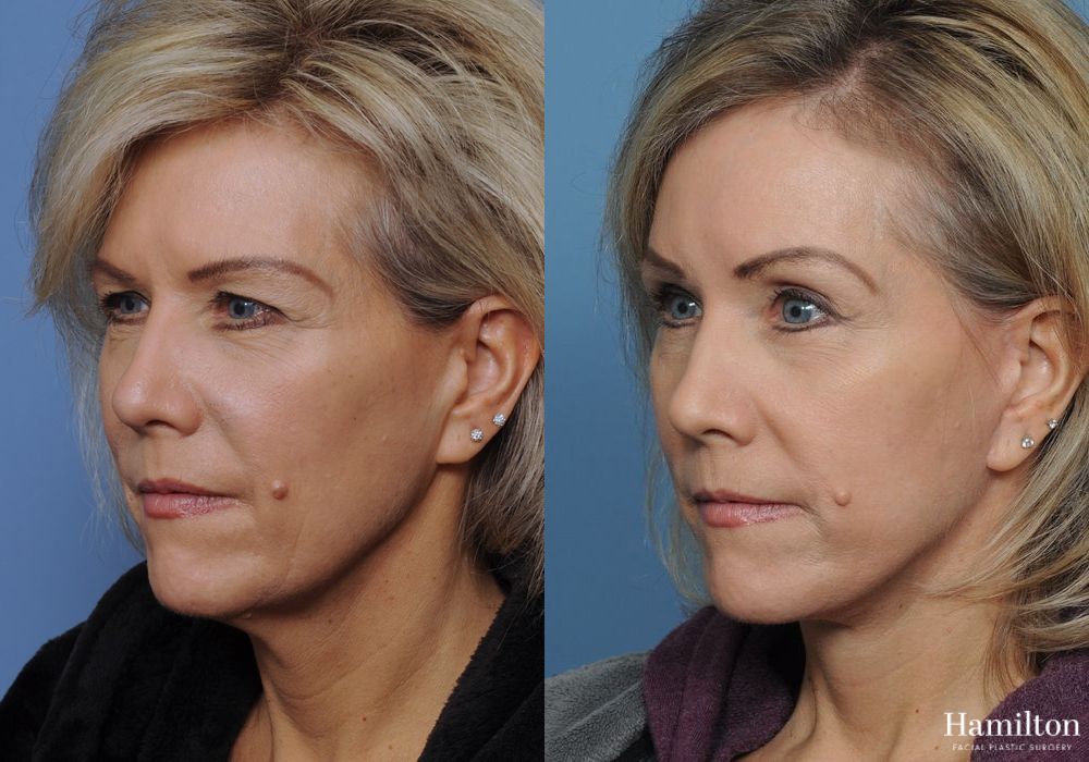 Before and after Brow Lift case 37151 - Angle 3