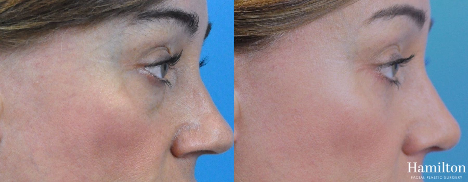 Before and after Blepharoplasty case 37285 - Angle 3