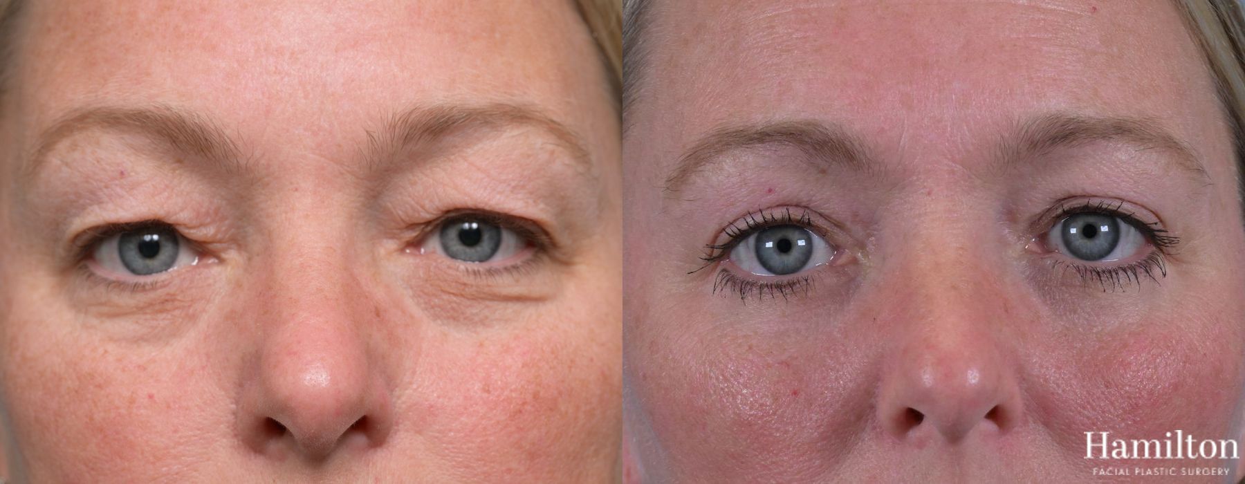 Before and after Blepharoplasty case 37119