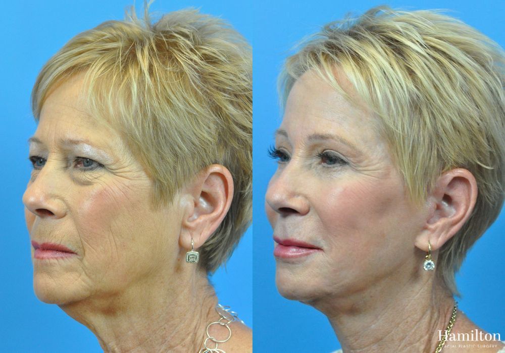 Before and after Laser - CO2 case 37107