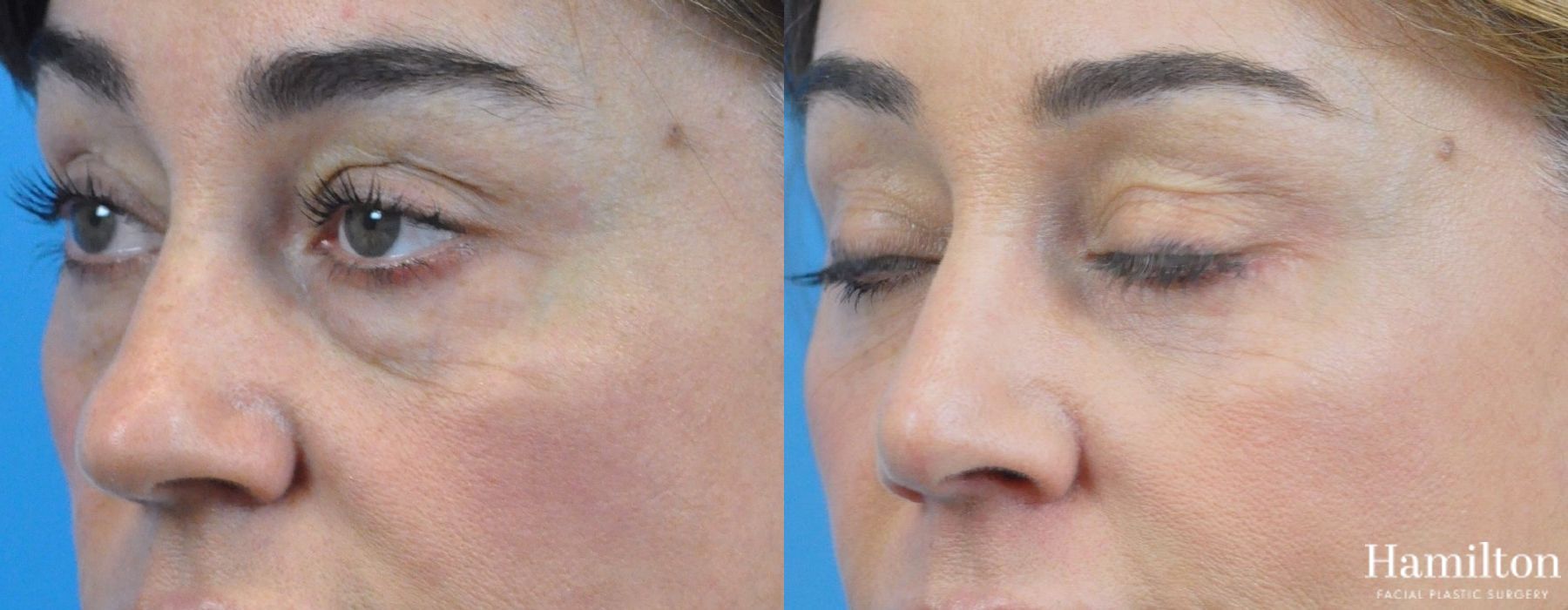 Before and after Blepharoplasty case 37285 - Angle 4