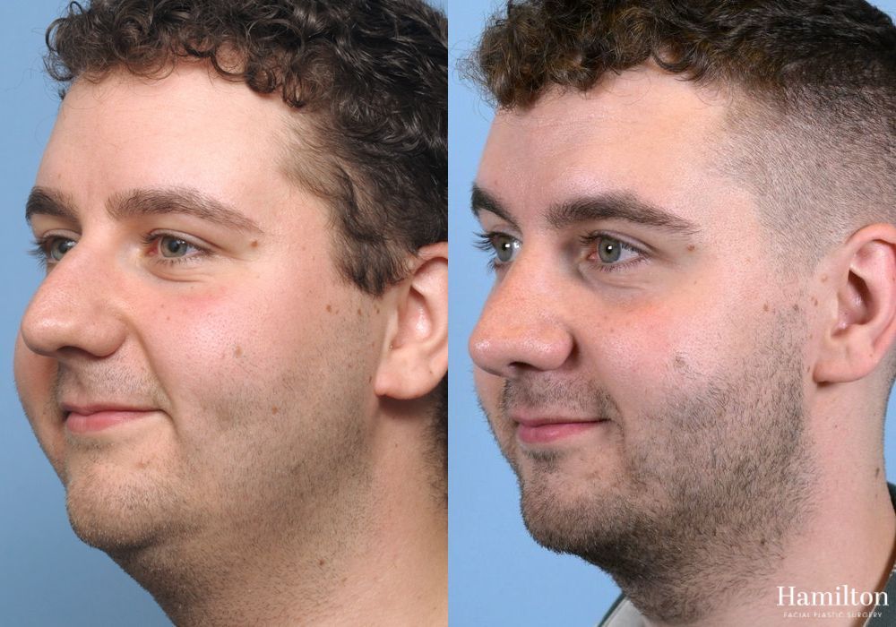 Before and after Rhinoplasty case 37236 - Angle 4