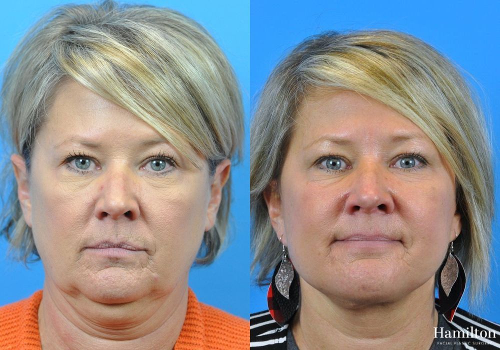 Before and after Neck Rejuvenation case 37172 - Angle 3