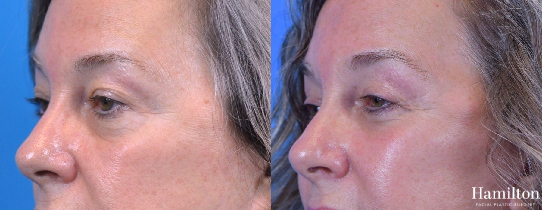 Before and after Blepharoplasty case 37310 - Angle 2