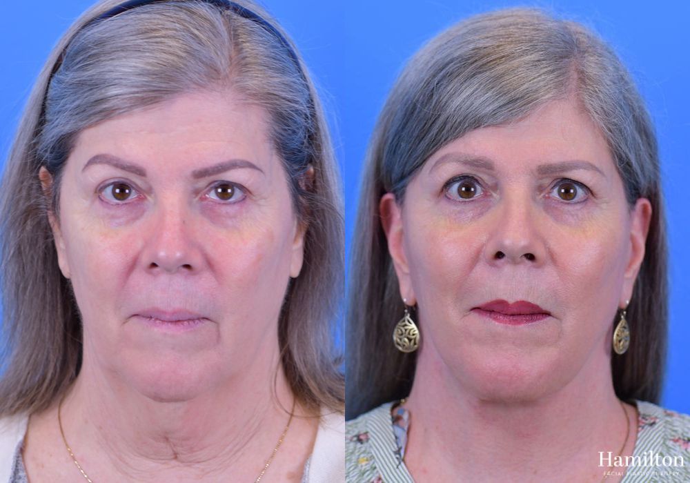 Before and after Neck Rejuvenation case 37194 - Angle 3