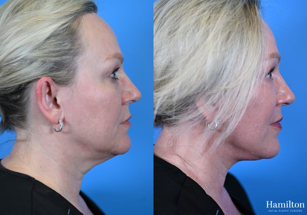 Before and after Facelift case 37317 - Angle 4