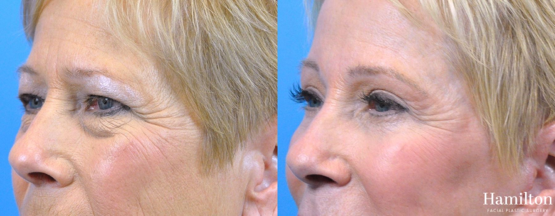 Before and after Blepharoplasty case 37088 - Angle 2
