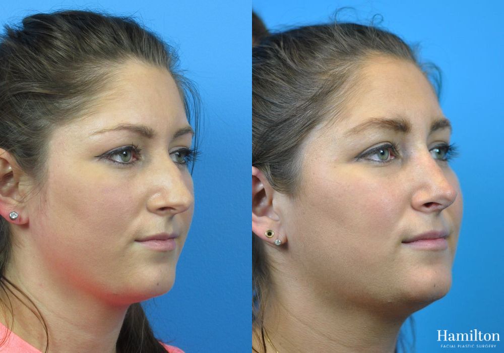 Before and after Rhinoplasty case 37313 - Angle 4